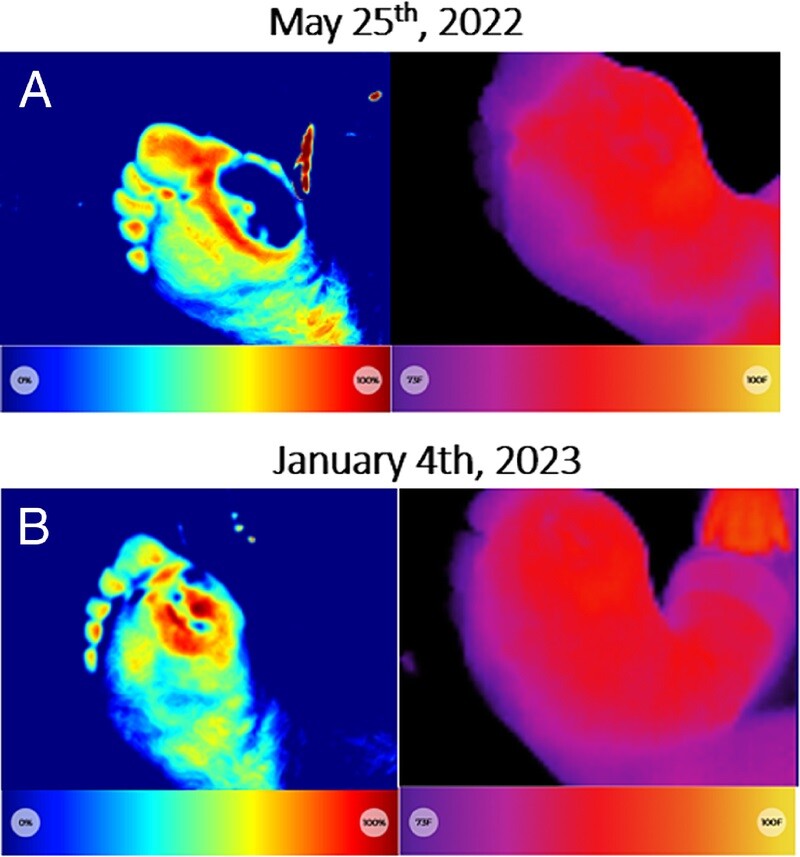 Publication Alert 📢

We are thrilled to present our latest publication titled: Using Near-Infrared Spectroscopy and Education to Support Older Adults with Diabetic Foot Ulcers to Age-in-Place: A Case Series.

Read more here: tinyurl.com/55bntzj3