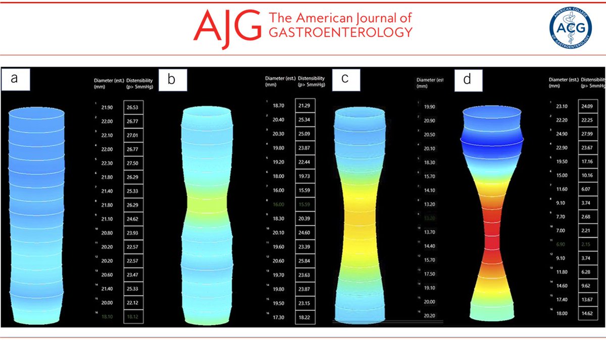 AmJGastro's tweet photo. In the 📕#RedJournal:

Use of Impedance Planimetry in the Diagnosis of Gastric Sleeve Stenosis: The Establishment of New Benchmark Values
Evans, et al. 

👉 https://t.co/soRnxpmmUE
@JessicaYuMD @bmmoy1 @allie_schulman https://t.co/bJ504nf0OG