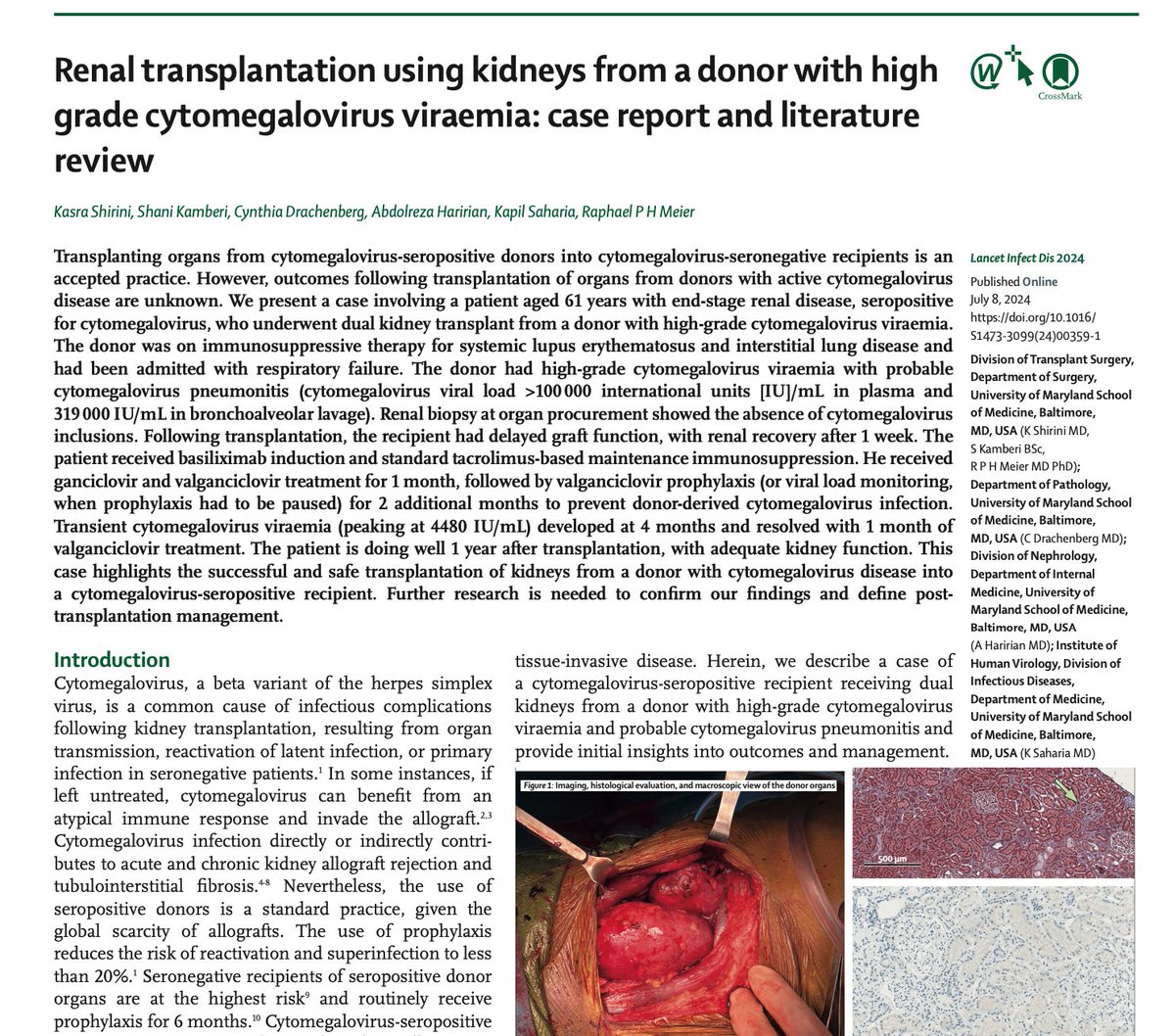 Raphael Meier MD-PhD (@meier_raphael) on Twitter photo Renal transplantation using kidneys from a donor with high-grade CMV viremia >100 000 IU/mL? We describe the first case ever in <a href="/TheLancetInfDis/">The Lancet Infectious Diseases</a> | <a href="/KasraShirini/">Kasra Shirini</a> | #RenalTransplantation #Cytomegalovirus #CMV #Valganciclovir #TransplantResearch | authors.elsevier.com/a/1jOfA5E-UogW… Renal transplantation using kidneys from a donor with high-grade CMV viremia >100 000 IU/mL? We describe the first case ever in <a href="/TheLancetInfDis/">The Lancet Infectious Diseases</a> | <a href="/KasraShirini/">Kasra Shirini</a> | #RenalTransplantation #Cytomegalovirus #CMV #Valganciclovir #TransplantResearch | authors.elsevier.com/a/1jOfA5E-UogW…