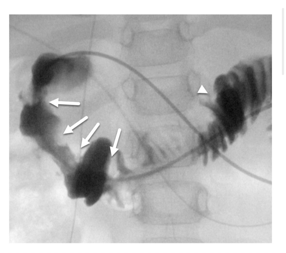 Hot off the press! A case report about multiple acquired duodenal webs treated by a combined endoscopic technique. onlinelibrary.wiley.com/doi/epdf/10.10… <a href="/JPGNonline/">JPGN</a> #pediatricGI #endoscopy