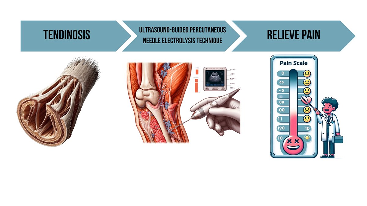 JSportRehab's tweet photo. Free to Read! Matheus Hissa Lourenço Ferreira and colleagues report moderate to high evidence supports percutaneous needle #electrolysis to reduce #pain in #tendinosis 
https://t.co/091UO0pju0
@ClinicDraBlanca Instagram: @guifisio, @blanca_academy
#tendinopathy #modalities https://t.co/AUy6UUxmkW