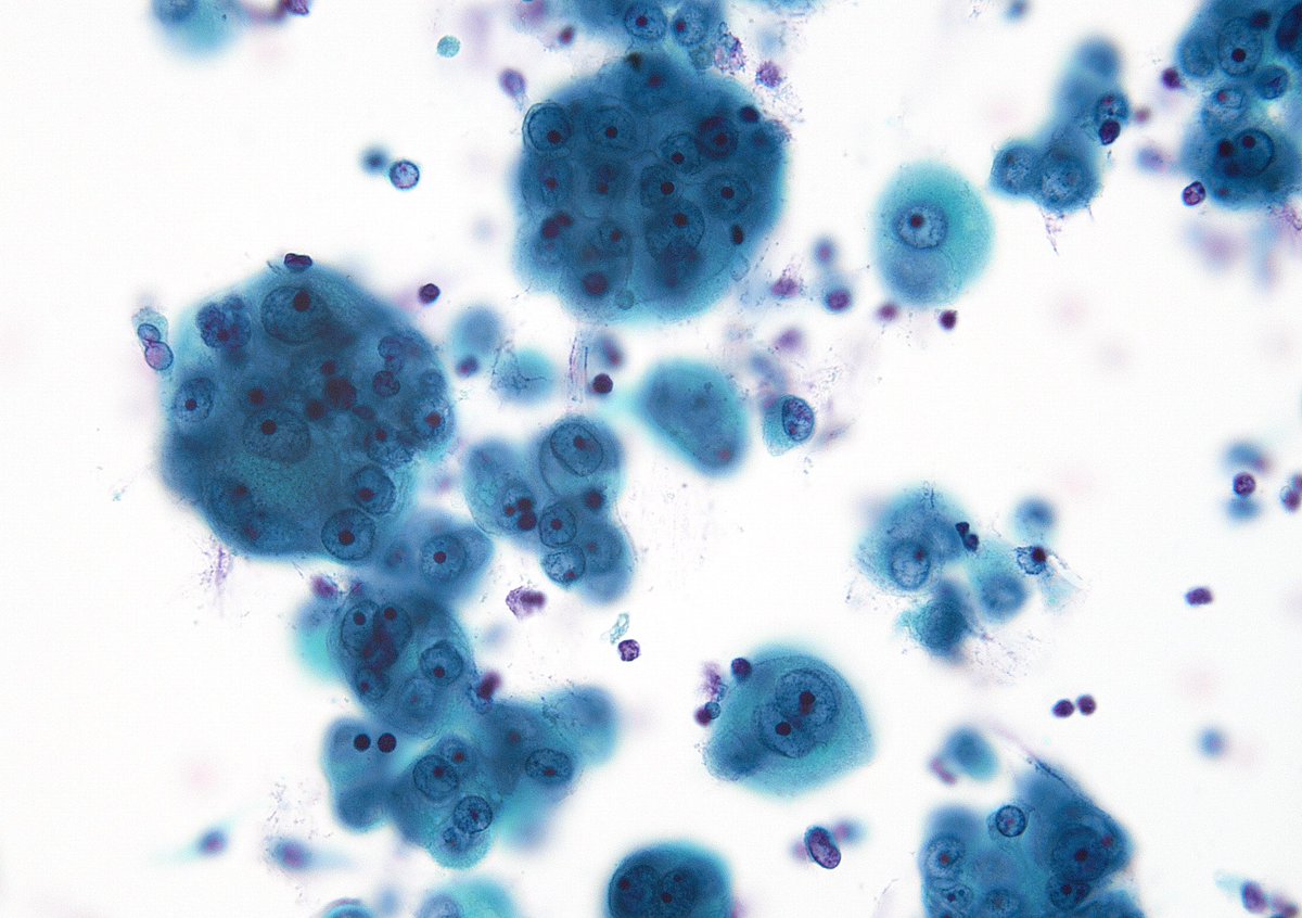 sza_jhcyto's tweet photo. “Mulberries or Morules” - nice cytomorphology of an “Epithelioid Mesothelioma” in pleural effusion. Macronucleoli are truly impressive. (Cytospin) https://t.co/9NrzDCrRhT