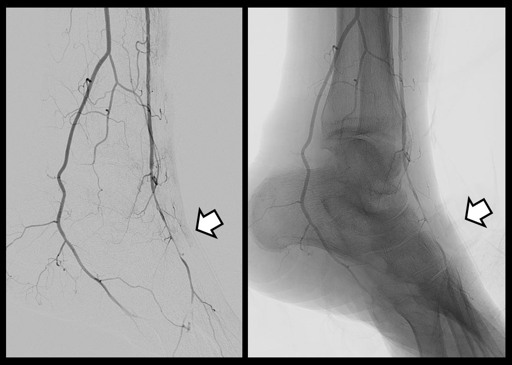 ForgeMedical's tweet photo. Does your radial/tibial hemostasis device do this? Preservation of antegrade flow through dorsalis pedis with #VasoStat in place (arrow) after removal of retrograde sheath used during rendezvous for tibial CTO. #pedalfirst #radialfirst https://t.co/nGnHVvEoaj