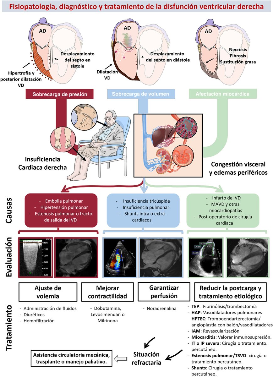 🆕 Disfunción del ventrículo derecho: Fisiopatología, evaluación y tratamiento.

📕 Rev Esp Cardiol <a href="/carlosreal42/">Carlos Real</a>
📁 cardioteca.com/cardiologia-cl…