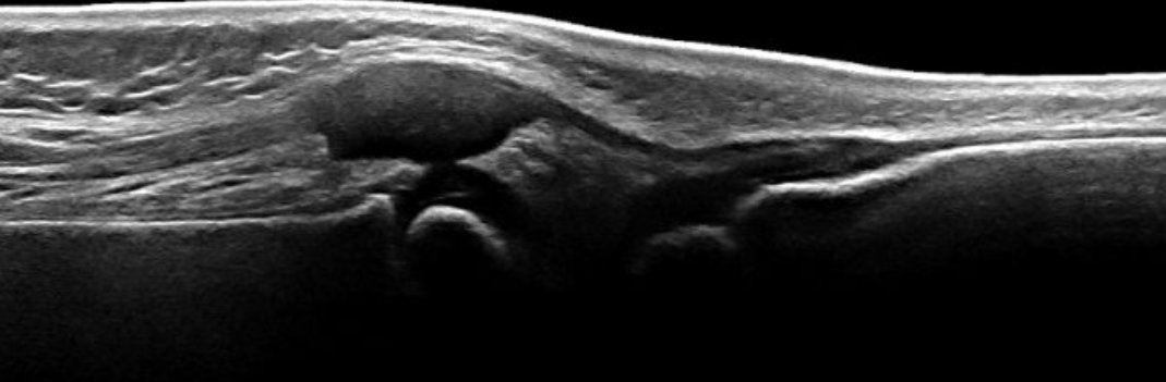 Jeffrey Tutman (@jeffreytutman) on Twitter photo Looking forward to kicking off the SPR MSK Ultrasound Webinar Series this Friday, July 12 at Noon ET! Registration is free for <a href="/SocPedRad/">The Society for Pediatric Radiology</a> members spr.org/events/mskultr… Looking forward to kicking off the SPR MSK Ultrasound Webinar Series this Friday, July 12 at Noon ET! Registration is free for <a href="/SocPedRad/">The Society for Pediatric Radiology</a> members spr.org/events/mskultr…