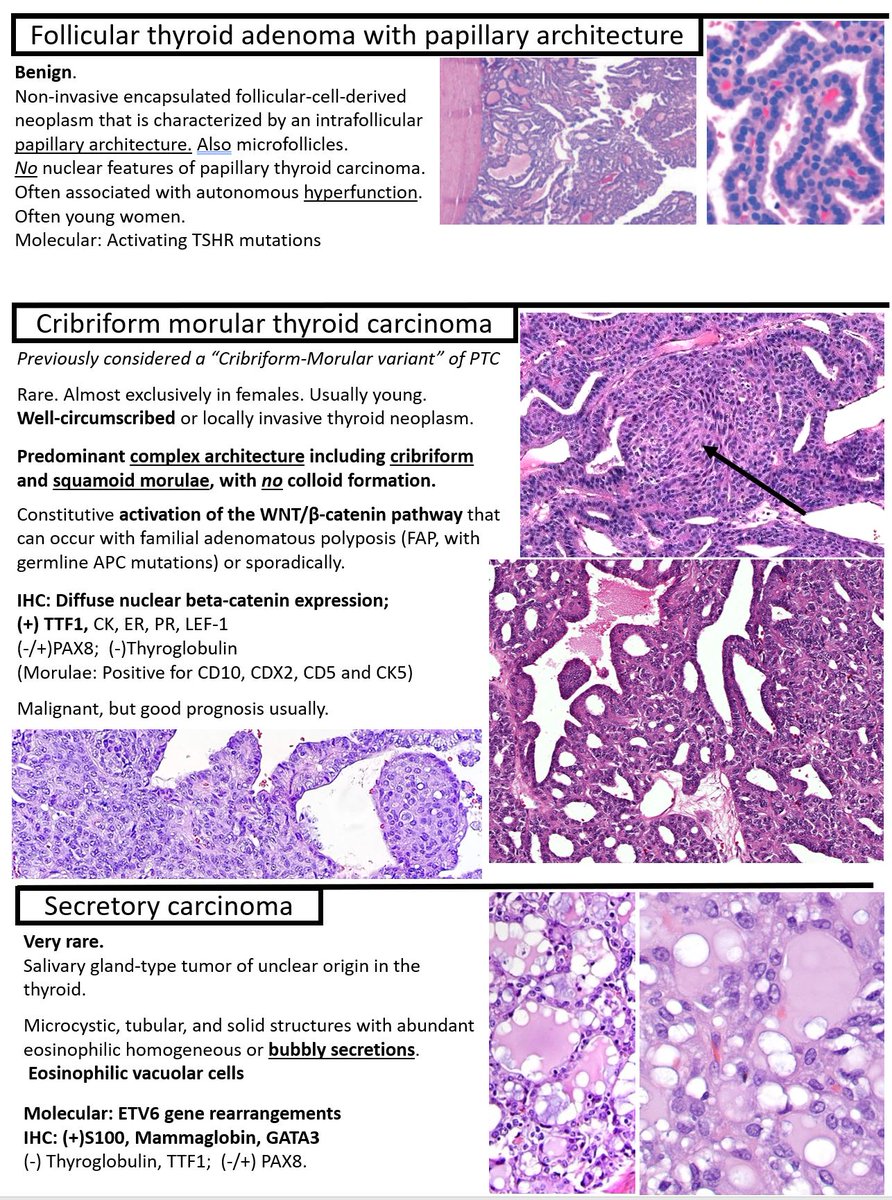KurtSchaberg's tweet photo. I just revised my notes on Thyroid Tumors for my teaching website, "Kurt's Notes" (https://t.co/OKmaPvGQpJ).   These new notes include the updated WHO terminology.

🔬🔬🔬🔬🔬🔬🔬🔬🔬🔬🔬🔬🔬🔬🔬🔬🔬🔬🔬🔬🔬🔬🔬🔬🔬🔬🔬🔬

Full notes available here: https://t.co/QX2fXOaDTe https://t.co/GmaQtlGHHu
