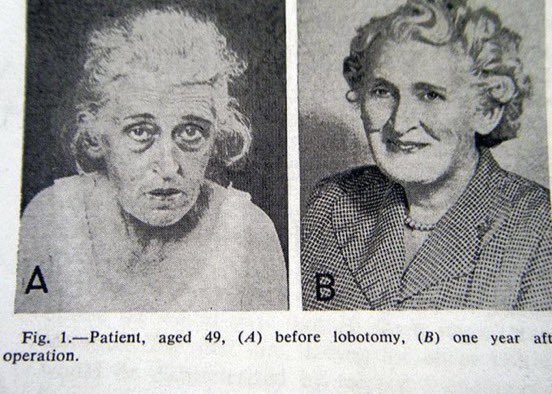 MorbidKnowledge's tweet photo. People before and after lobotomies. https://t.co/2vtbni9V4Z