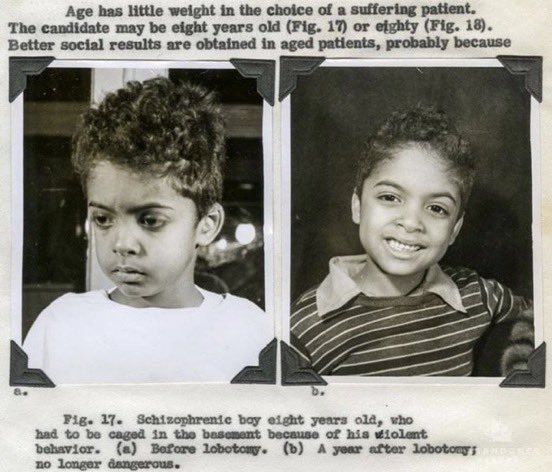 MorbidKnowledge's tweet photo. People before and after lobotomies. https://t.co/2vtbni9V4Z