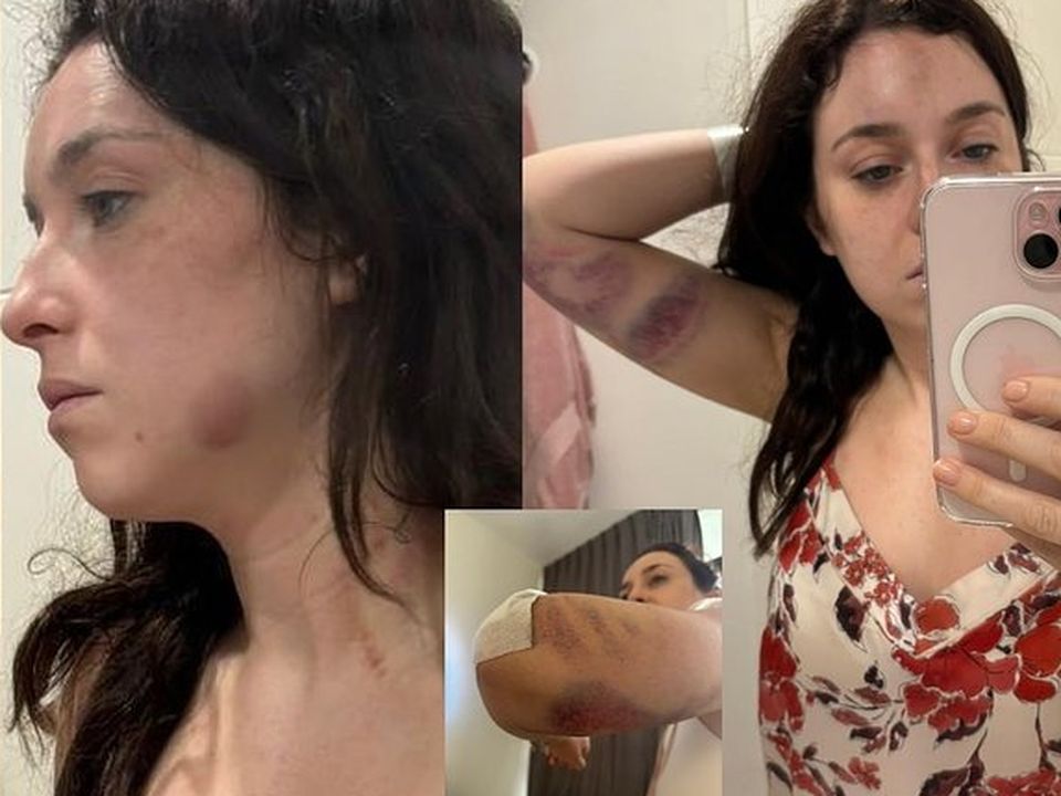 An Irish woman has been banned from leaving Dubai and is facing criminal charges after she was allegedly attacked in her home.

Tori Towey, suffered severe bruising and other injuries that required hospital treatment, according to Detained in Dubai.

Absolutely backward, get her