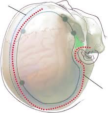 Afgneurosurgeon's tweet photo. #Subdural #Hematoma
In patients presenting with worst clinical status, outcomes are poor regardless of surgical method. Older age and lower GCS score are independently associated with greater mortality risk of patients undergoing decompressive Craniotomy https://t.co/IPSGfpZKoZ