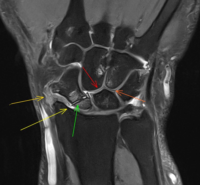 10/7/2024. 🟧💁 Male 28 years-old with longstanding pain after trauma in his right wrist 🤚, years ago. 

A #MRI is performed. 

Some features are pointed with different arrows. 
What´s your diagnosis? 
The result is coming soon. Stay tunned. 

#MSK #wristpain #traumatwitter