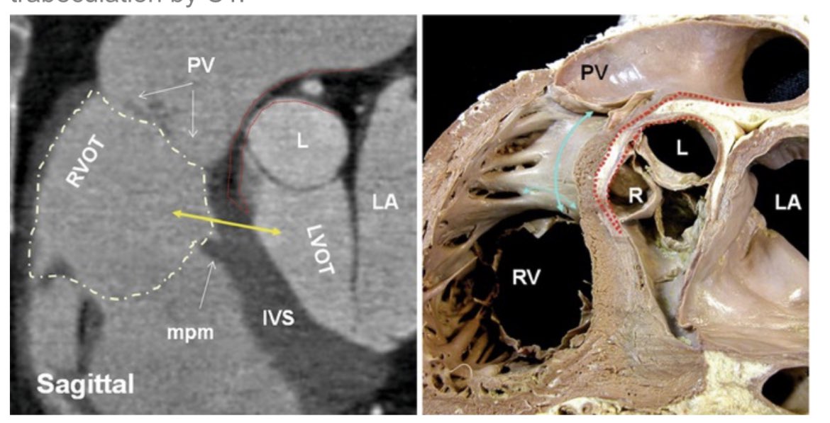 Edward Cheng, MD, PhD (@drepcheng) on Twitter photo PVC with abrupt V3 transition suggested L-R interleaflet triangle exit. Broad left sided early activation and poor pace mapping. Got it from below pulmonic valve w/ 98% match. Anatomy relationship always an a-ha moment. Excellent mapping <a href="/forkknifecab_EP/">Brock Gambill</a> <a href="/georgecrowell/">George Crowell</a> #EPeeps PVC with abrupt V3 transition suggested L-R interleaflet triangle exit. Broad left sided early activation and poor pace mapping. Got it from below pulmonic valve w/ 98% match. Anatomy relationship always an a-ha moment. Excellent mapping <a href="/forkknifecab_EP/">Brock Gambill</a> <a href="/georgecrowell/">George Crowell</a> #EPeeps