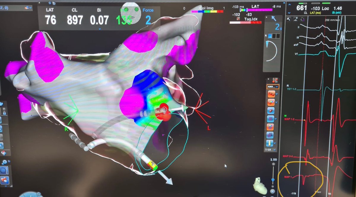 Rodolfo San Antonio (@dr_sanantonio) on Twitter photo Unifocal PAC (and atrial tachycardia) arising from anteroseptal mitral annulus. Totally negative deflection (QS) of the unipolar EGM <a href="/Davidsotoiglesi/">David soto-iglesias</a> <a href="/Hospital_HUGC/">Hospital Universitari General de Catalunya</a> Unifocal PAC (and atrial tachycardia) arising from anteroseptal mitral annulus. Totally negative deflection (QS) of the unipolar EGM <a href="/Davidsotoiglesi/">David soto-iglesias</a> <a href="/Hospital_HUGC/">Hospital Universitari General de Catalunya</a>
