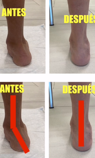 ClinicaCEMTRO (@clinicacemtro) on Twitter photo 🦶🏻Pie plano valgo en adulto:
‼️Se inicia con una insuficiencia de tendón tibial posterior y pérdida de arco plantar
👉🏻En fases avanzadas puede desarrollar #artrosis
🥼Caso: Doble osteotomía de calcáneo+osteotomía en la cuña medial
👨🏻⚕️Vía <a href="/DrSergiohorte/">Dr. Sergio Hortelano</a> - clinicacemtro.com/cemtro-premium… 🦶🏻Pie plano valgo en adulto:
‼️Se inicia con una insuficiencia de tendón tibial posterior y pérdida de arco plantar
👉🏻En fases avanzadas puede desarrollar #artrosis
🥼Caso: Doble osteotomía de calcáneo+osteotomía en la cuña medial
👨🏻⚕️Vía <a href="/DrSergiohorte/">Dr. Sergio Hortelano</a> - clinicacemtro.com/cemtro-premium…