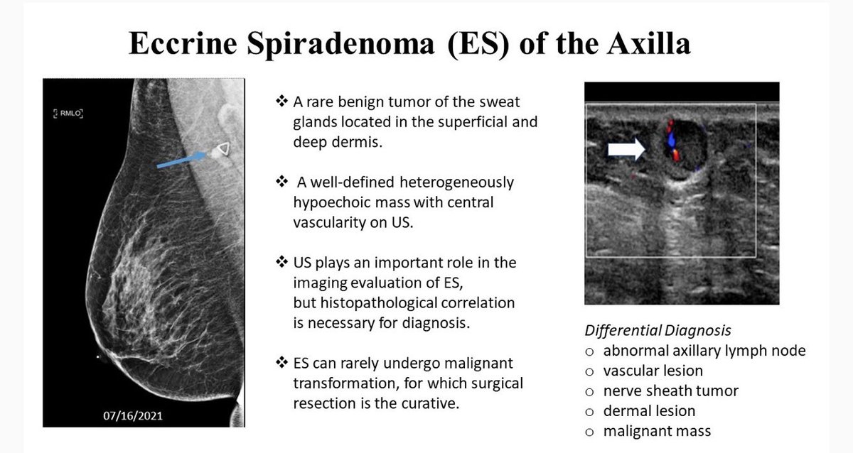 📣🌟 Latest #JBI UNKOWN CASE 🌟📣 
by <a href="/mindyLyang/">Mindy Yang MD</a> : Palpable Mass in the Axilla

Read more 👇🏻👇🏽👇🏾
📩 doi.org/10.1093/jbi/wb…

#BreastCancer #Breastimaging #Radiology #case #axilla