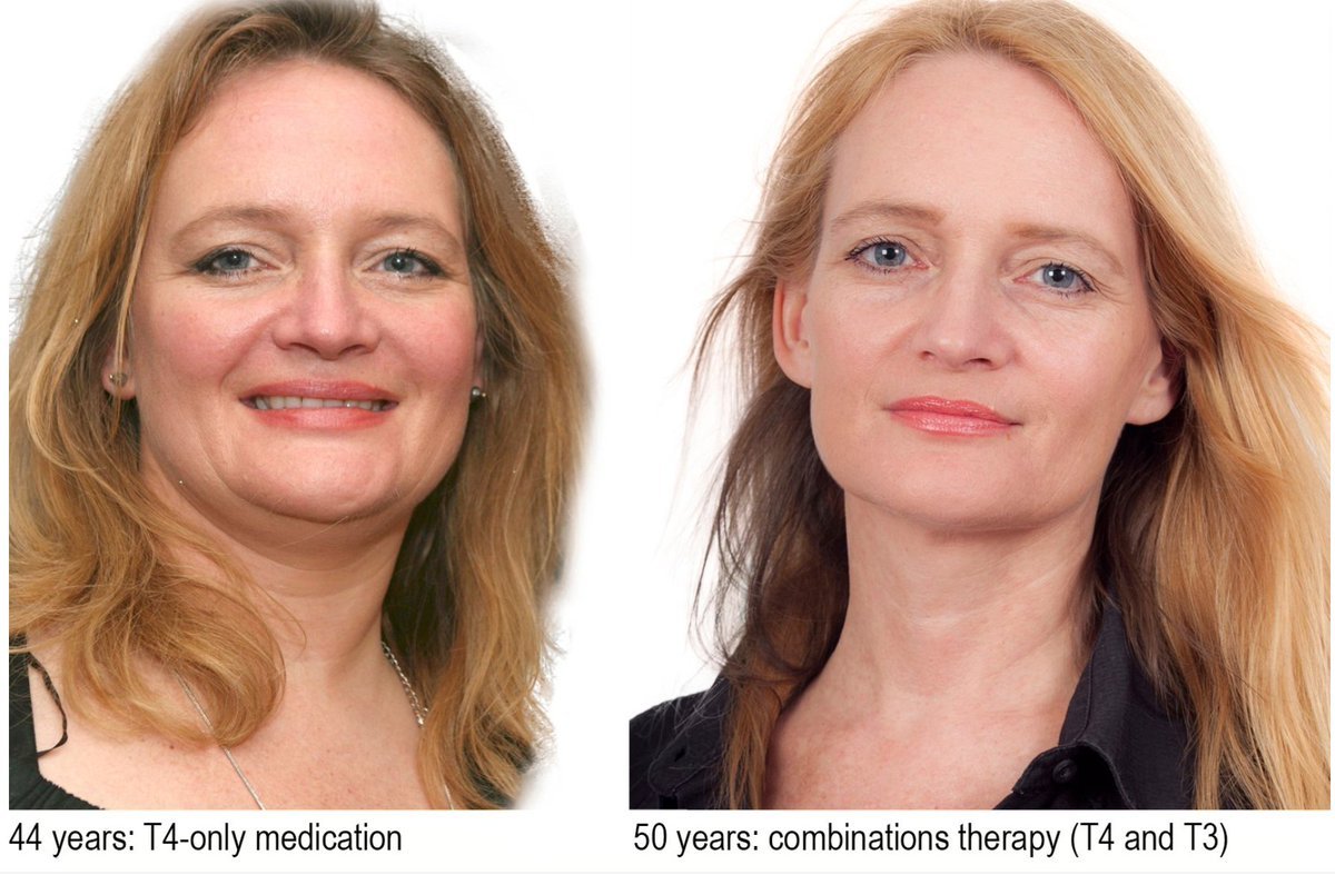 nootroplanet's tweet photo. Quelle est la différence entre être en bonne santé, en forme, attrayant, heureux et être physiquement incapable, c'est-à-dire :

Malade, fatigué, peu attrayant, et déprimé ?

THYROÏDE BASSE

Il est temps de parler de la thyroïde.

🧵 https://t.co/W85Ll3dsmF