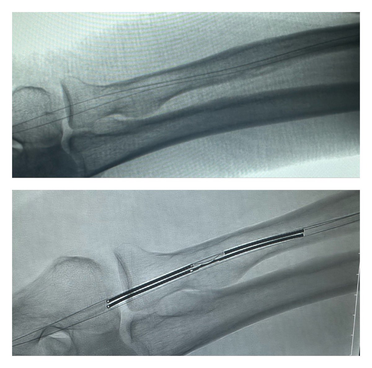 YousofAlZahrani's tweet photo. Always pay attention to the small venous channels to ensure proper positioning of wires and #WavelinQ catheters!
#EndoAVF #ESKD #AVF https://t.co/egR5EIfXLW