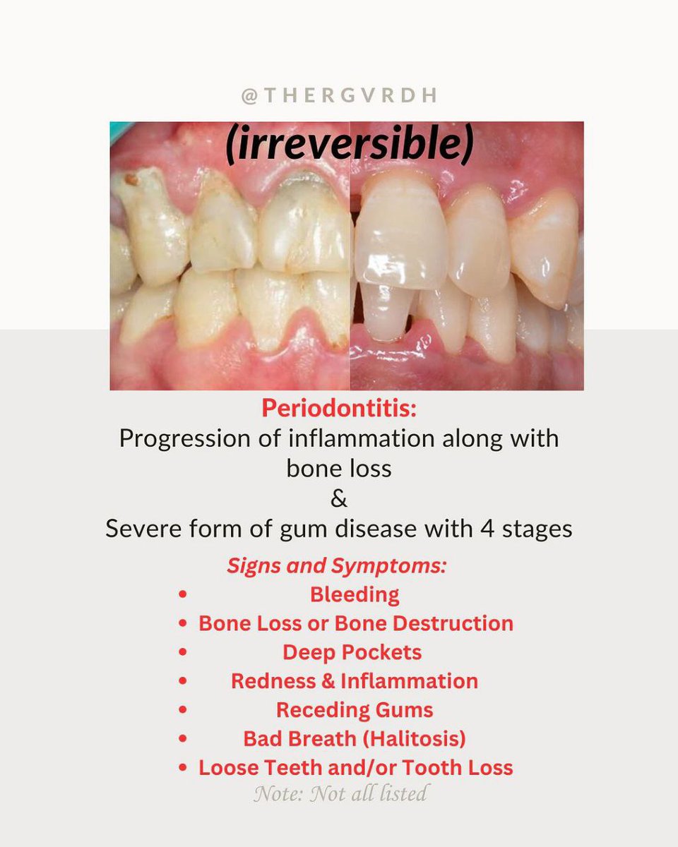 asnan_tbyb's tweet photo. Difference between Gingivitis and periodontitis 

الصورتين دول جايبين الفروقات من ناحية هل هو Reversible or not 
وكمان الأعراض 

صورتين حلوين ومفيدين ♥️ https://t.co/ohrB5fVbua
