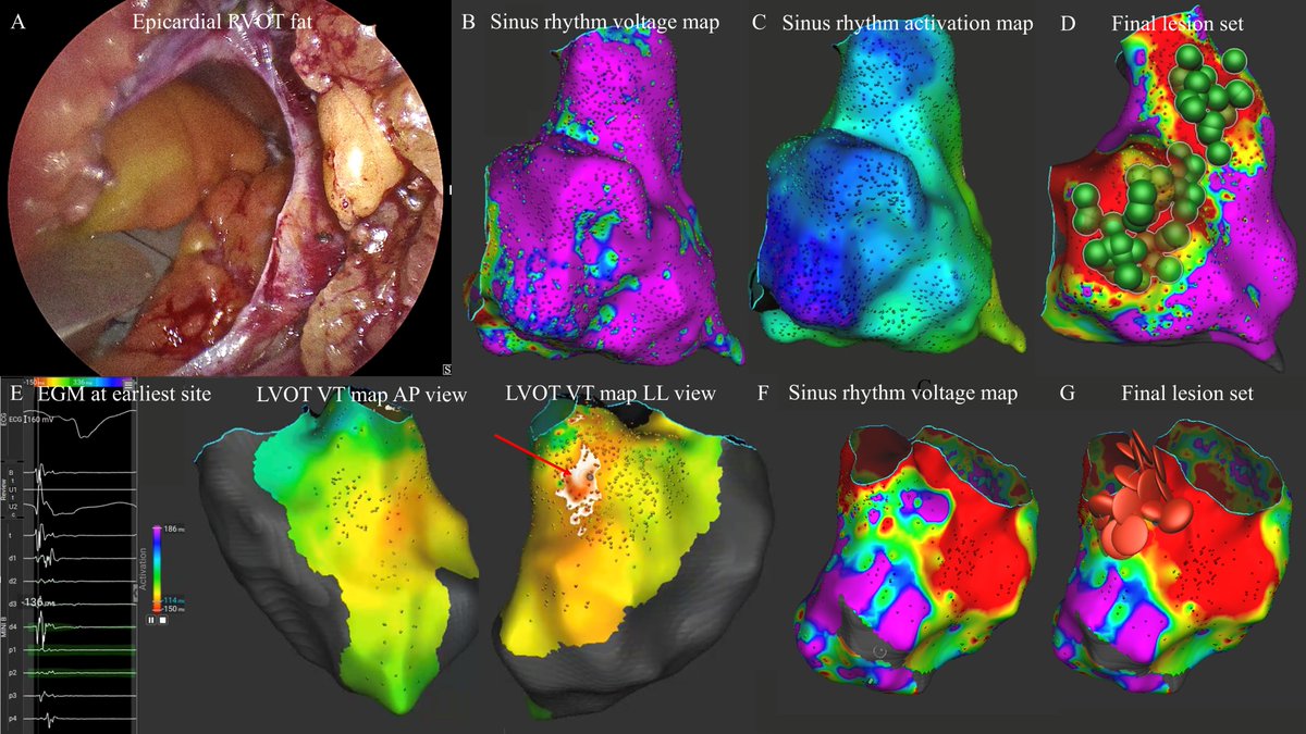 LuigiPannone_MD (@luigipannonem) on Twitter photo We are delighted to share the first clinical experience with the Sphere-9 catheter for VT ablation. Promising results using both pulsed field and radiofrequency energy. <a href="/AndreaSarkozy/">Andrea Sarkozy</a> @CdeAsmundis <a href="/IDoundoulakis/">Ioannis Doundoulakis</a> <a href="/dogi84md/">Domenico Giovanni Della Rocca, MD</a> <a href="/cespon_maria/">María Cespón</a> <a href="/HRMCBrussel/">Heart Rhythm Management Center</a>
academic.oup.com/europace/advan… We are delighted to share the first clinical experience with the Sphere-9 catheter for VT ablation. Promising results using both pulsed field and radiofrequency energy. <a href="/AndreaSarkozy/">Andrea Sarkozy</a> @CdeAsmundis <a href="/IDoundoulakis/">Ioannis Doundoulakis</a> <a href="/dogi84md/">Domenico Giovanni Della Rocca, MD</a> <a href="/cespon_maria/">María Cespón</a> <a href="/HRMCBrussel/">Heart Rhythm Management Center</a>
academic.oup.com/europace/advan…