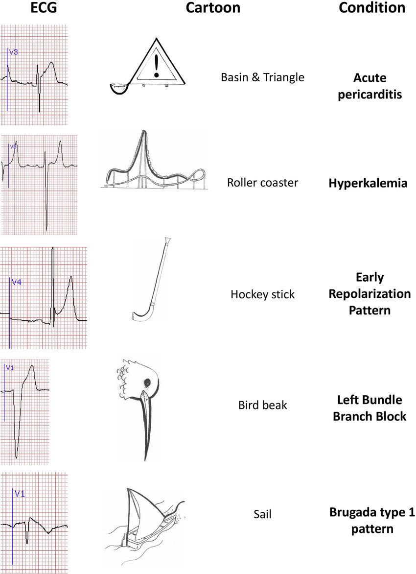 clinicallog's tweet photo. Useful ways to remember #ECG patterns https://t.co/eGkvC478OG