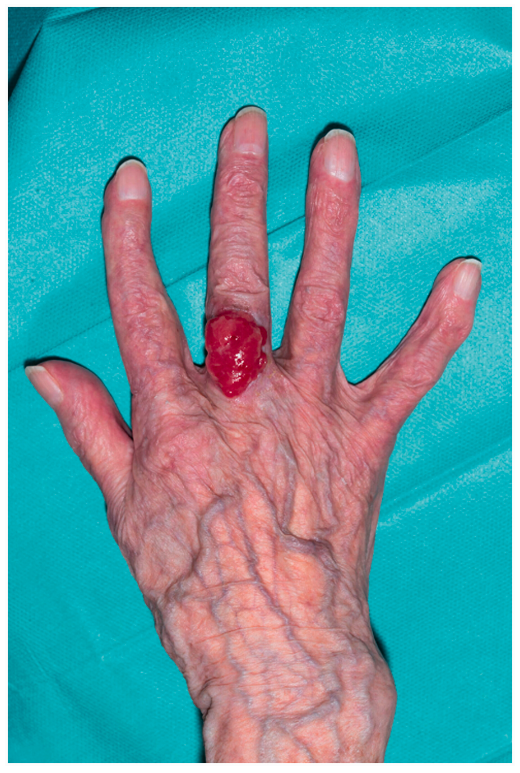 JHSEur's tweet photo. 🗣️Do you know the A B C D E of Malignant Melanoma in the hand?

Melanoma is a type of skin cancer that originates in the melanocytes, the cells responsible for producing melanin. While less common, melanomas can occur on the hand and pose significant health risks. #Melanoma #SkinCancer #dermatology