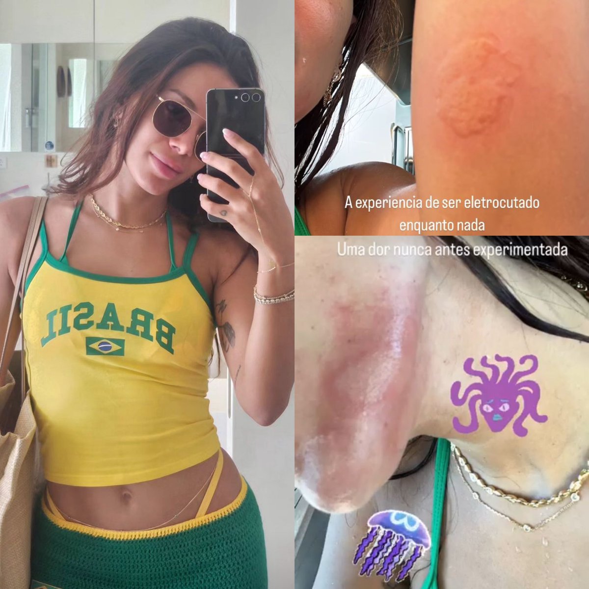 HugoGloss's tweet photo. O susto!🪼A diva @anitta está em viagem em Ibiza, na Espanha, e foi eletrocutada por uma água-viva. Ela mostrou os machucados após o encontro com o animal nas redes sociais. Tadinha! 💔 (📸: @anitta) https://t.co/lntg3czPcW
