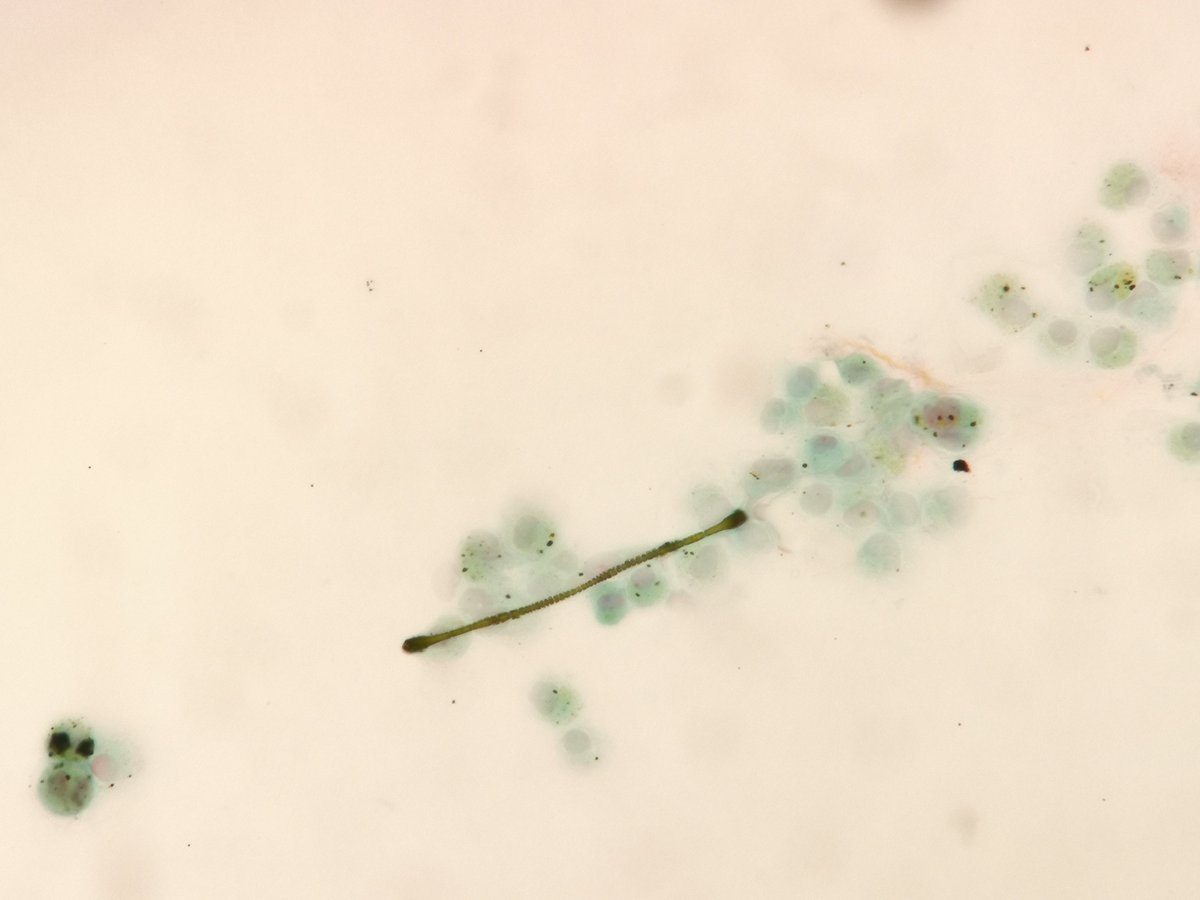 MirunaPopescu13's tweet image. #Cytopath #Pulmpath
BAL fluid. Can you name this beauty I found 🏋️? 

#PathTwitter