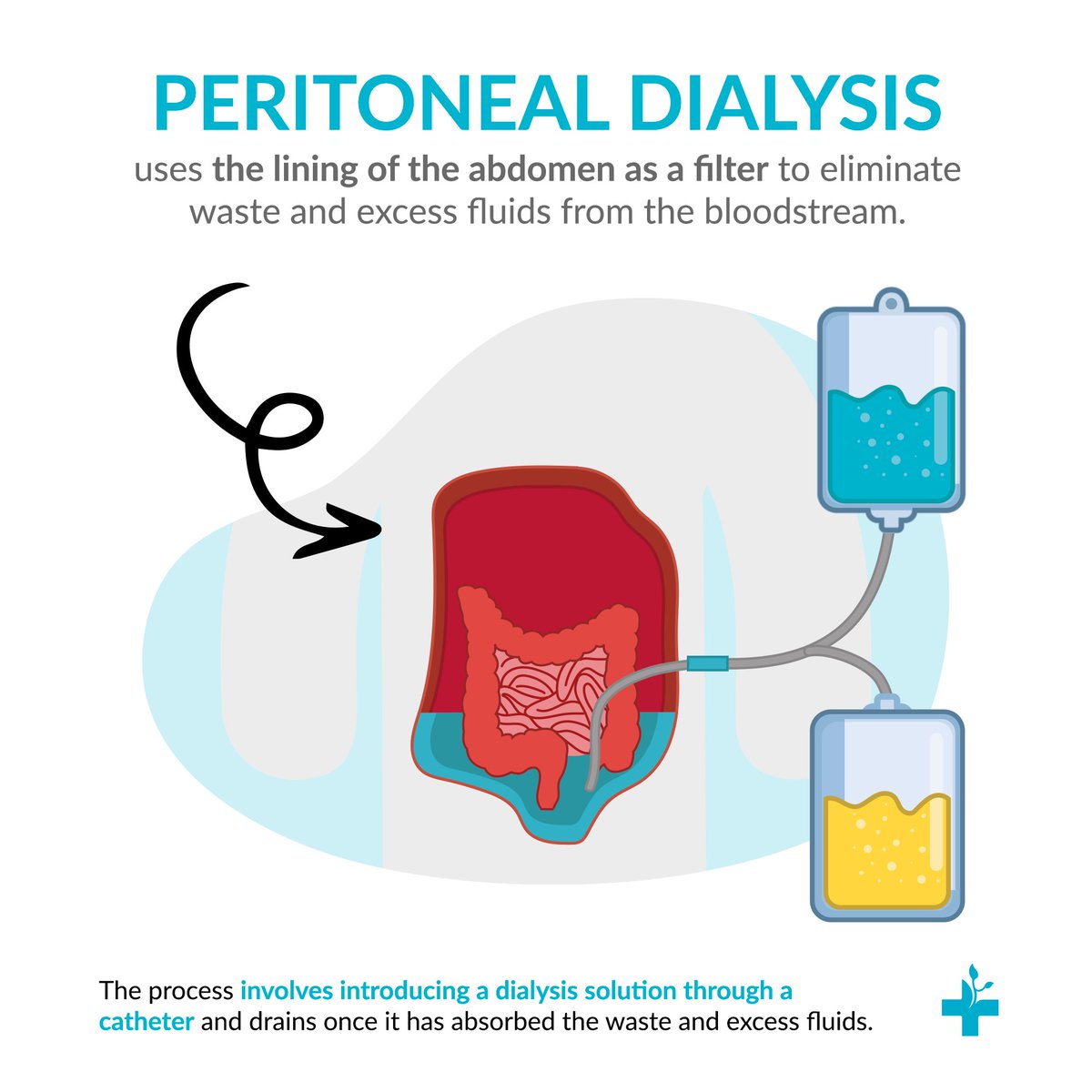 CarmenHealth's tweet photo. Peritoneal dialysis is one of the kidney treatments that exist to treat CKD. 

Visit Carmen to find out if this treatment is suitable for you.

#CarmenKidneyHealth #CKD #Dialysis #Hemodialysis #PeritonealDialysis https://t.co/dAuyrLRTg2