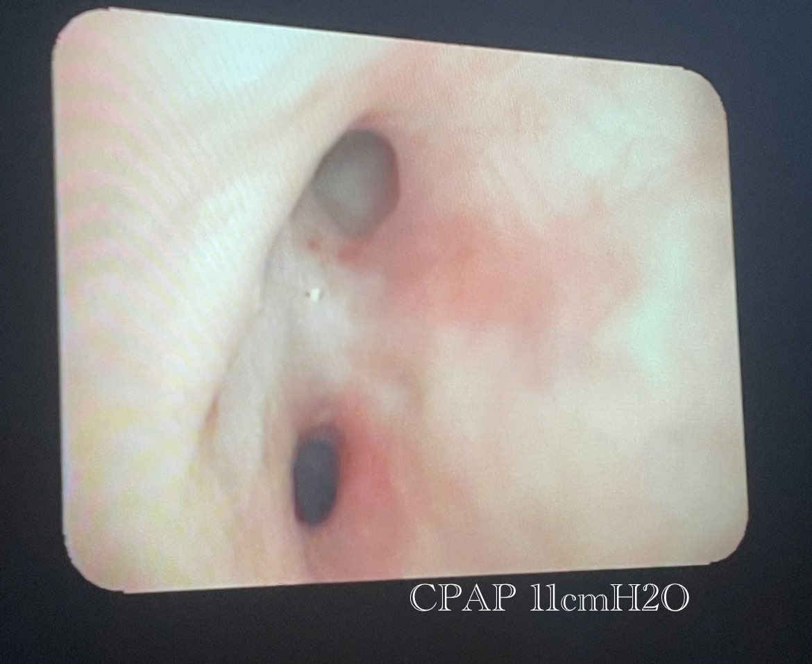 Hoy U. Broncoscopias + UCRI, hemos hecho una titulación de CPAP bajo sedación en paciente #trasplantado pulmonar con complicación de #estenosis bronquial y #broncomalacia.
Muy ilustrativas las imágenes! @ainhoa_izq <a href="/cristinaggallo/">Cristina</a>