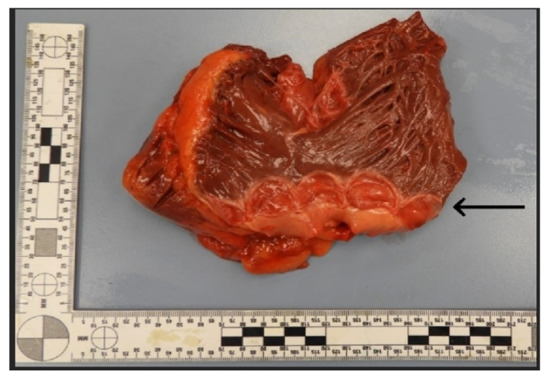 CardioServ's tweet photo. Found this interesting #cardiology article and thought it was worth sharing. I have never seen a quadricuspid PV.  What's the strangest number of cusps you've seen on a valve? #cardiotwitter  #echolife 
https://t.co/BomqFug82D https://t.co/13UsUEG47Y