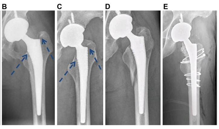 JArthroplasty's tweet photo. A P3 is the greatest risk factor for PFF, followed by canal flare index (CFI), osteoporosis, canal bone ratio (CBR), age, P4, P1, stem design, canal calcar ratio (CCR), BMI, and P2. Both the design and size of the stem are modifiable risk factors.

https://t.co/D5cdl0tyln https://t.co/aqgrEflVlT