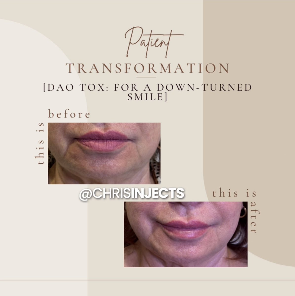 chrisinjects's tweet photo. Transform your frown into a fabulous smile! Check out these stunning before and after results from DAO tox injections. Say goodbye to that downturned smile and hello to confidence! 

💉 Chris Padilla, BSN, RN
💉Aesthetic Nurse Injector
🗓️ Book with me, link in bio https://t.co/fcn63BGZ31