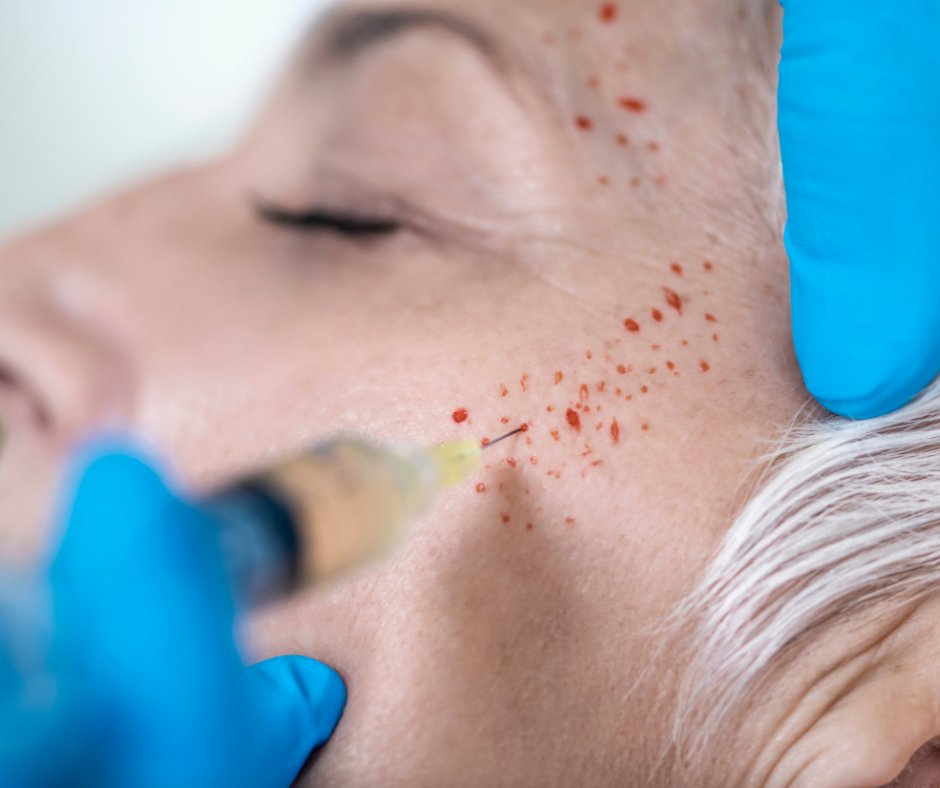 SmoothSynergy's tweet image. Face PRP is a great way to go to rejuvenate the skin. So which PRP treatment is right for you? We're breaking down the difference between Microneedling with PRP vs. The PRP Vampire Facial vs. The PRP Vampire Facelift. Here's all you need to know: smoothsynergy.com/prp-nyc