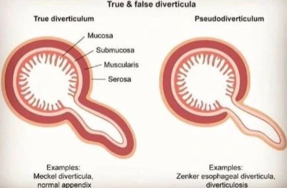 drkeithsiau's tweet photo. @DivagoTM You’re right! A true diverticulum has a muscle layer and is therefore harder to perforate! https://t.co/404XEcFuK1