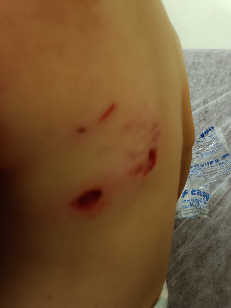 Adıyaman Besni'de başıboş köpekler, 3 yaşındaki bir kız çocuğuna saldırarak ağır yaraladı