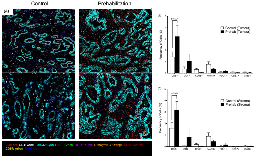 David Bartlett, PhD (@bartlett_lab) on Twitter photo Our preprint showing how prehabilitation #exerciseoncology 🟰 more tumour infiltrating CD8+ lymphocytes and tertiary lymphoid structures in #oesophagealcancer. <a href="/charles_rayner/">Charles Rayner</a> <a href="/UoS_Oncology/">Section of Oncology</a> <a href="/SurreySportSci/">Sport & Exercise Science @ University of Surrey</a> <a href="/RoyalSurrey/">Royal Surrey</a> <a href="/nima_ghadi/">Nima Abbassi-Ghadi</a> <a href="/Adam_Frampton1/">Adam Frampton</a> medrxiv.org/content/10.110… Our preprint showing how prehabilitation #exerciseoncology 🟰 more tumour infiltrating CD8+ lymphocytes and tertiary lymphoid structures in #oesophagealcancer. <a href="/charles_rayner/">Charles Rayner</a> <a href="/UoS_Oncology/">Section of Oncology</a> <a href="/SurreySportSci/">Sport & Exercise Science @ University of Surrey</a> <a href="/RoyalSurrey/">Royal Surrey</a> <a href="/nima_ghadi/">Nima Abbassi-Ghadi</a> <a href="/Adam_Frampton1/">Adam Frampton</a> medrxiv.org/content/10.110…