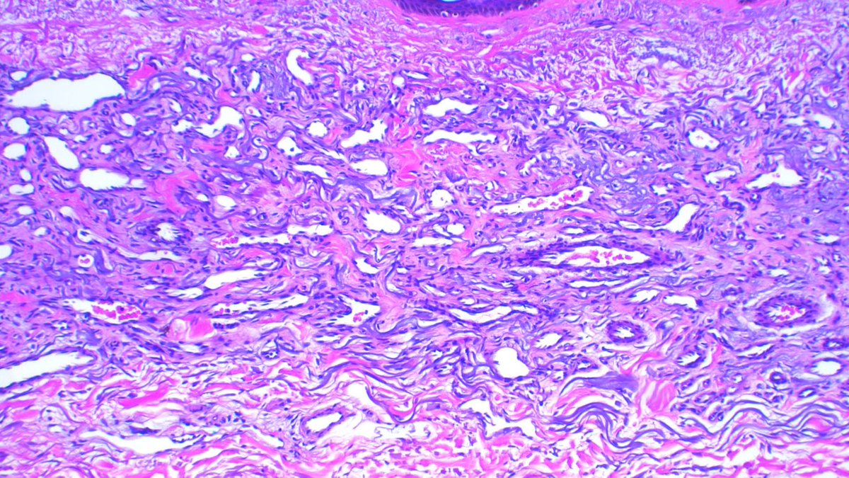 Int Soc Dermpath (@intsocdermpath) on Twitter photo #ISDP #Olympics2024
Spot diagnosis
Case 2 - <a href="/JCandidoXavier/">Jose Candido</a>
ACQUIRED ELASTOTIC HEMANGIOMA
•Proliferation of vascular channels surrounded and intertwined by intense solar elastosis.
•Erythematous lesions in sun-exposed areas of elderly patients
#pathology #medicine #derm #ISDP #Olympics2024
Spot diagnosis
Case 2 - <a href="/JCandidoXavier/">Jose Candido</a>
ACQUIRED ELASTOTIC HEMANGIOMA
•Proliferation of vascular channels surrounded and intertwined by intense solar elastosis.
•Erythematous lesions in sun-exposed areas of elderly patients
#pathology #medicine #derm