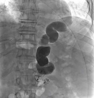 ‘Vampire bite’ jugular access for occluding dual efferents of lienorenal shunt.

62 year old gentleman with recurrent severe hepatic encephalopathy. 

With <a href="/shobhit_IR/">SHOBS</a>, <a href="/akhilbaby55/">Akhil Baby</a> and <a href="/theliverdr/">TheLiverDoc</a>