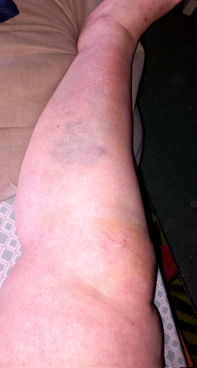 judefire33's tweet photo. Amazingly I have a f2f gp appointment on Monday about my poor knee! First time in over 18 months I've been given one! The knee is bloody awful by the way! ๐คฎ๐ค #IFellOver https://t.co/lUC3RSIBHu