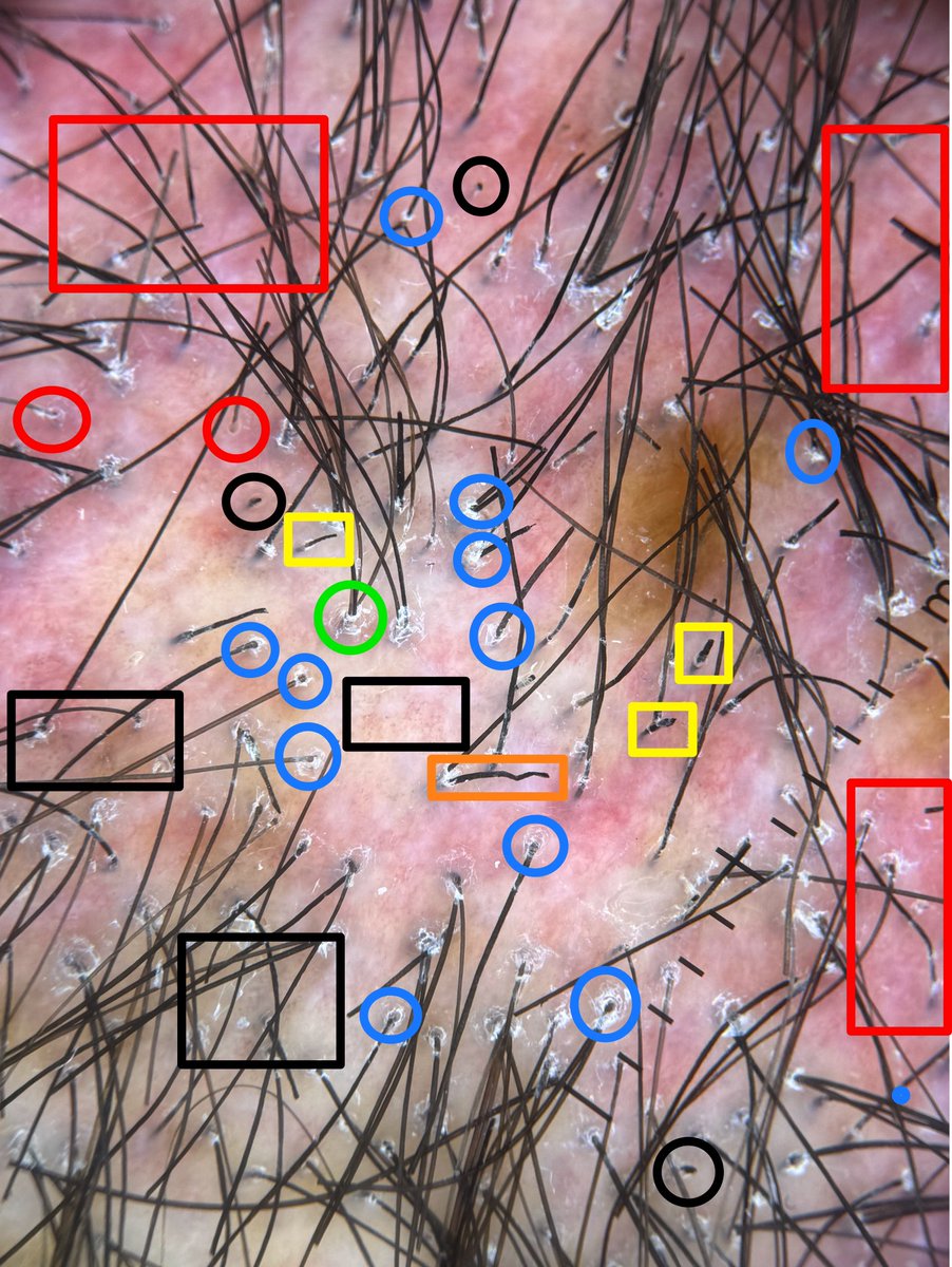 En la #tricoscopia del liquen plano pilar podemos ver: 
🔵 Hiperqueratosis perifolicular
🟢 Pseudopenachos 
🔴 Eritema perifolicular 
🟥 Áreas rojo-lechosas 
⚫️ Puntos negros 
⬛️ Punteado grisáceo-gránulos marrones 
🟧 Pili torti 
🟨 Pelos rotos 
#tricología #dermatología