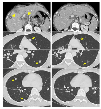 CathyEngMD's tweet photo. Interesting but early CAR-T results from @theNCI in @NatureMedicine: re:  7 #colorectal #cancer patients; 3 pts with response. However, median TTP= 4.6M.  DOI: 10.1038/s41591-024-03109-0.  Suggesting there may be a future role with additional research.  #cancerresearch @OncoAlert #crcsm
