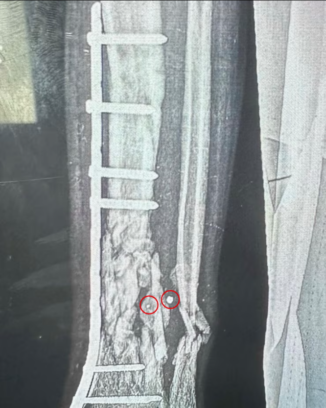 QudsNen's tweet photo. According to The Guardian, citing foreign surgeons who worked in Gaza, Israeli weapons designed to disperse high levels of shrapnel are inflicting severe injuries on civilians, particularly children.

The weapons, used in densely populated civilian areas, include missiles and shells packed with additional metal fragments intended to maximize harm.

Volunteer doctors at Gaza hospitals report that a significant portion of their surgeries involve children struck by tiny shrapnel pieces that cause extensive internal damage despite leaving nearly imperceptible entry wounds. Amnesty International has criticized these weapons for their apparent intent to cause maximum casualties.

Feroze Sidhwa, a trauma surgeon from California who worked at a hospital in southern Gaza, described treating numerous young children with injuries from these small but devastating shrapnel pieces: "About half of the injuries I treated were in young kids. The splinter injuries were minuscule—much smaller than anything I’ve encountered before—but they caused extensive internal damage."
