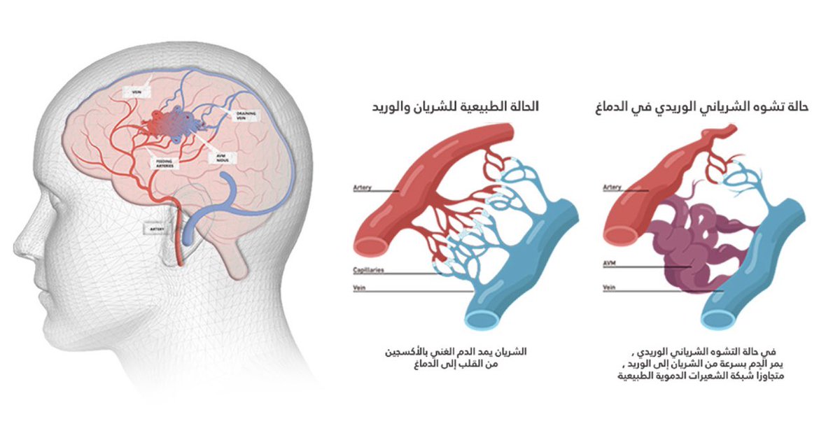 AAlboridy's tweet photo. تشوهات الأوعية الدموية قد تسبب مشاكل صحية كبيرة، ولكن بفضل الأشعة التداخلية، يمكن علاج هذه التشوهات بطرق غير جراحية وفعالة. هذه التقنية المبتكرة تتيح علاج الأوعية الدموية المتضررة بدقة وأمان. لاتتردد بطلب موعد واستشاره من خلال رابط الواتس آب 
#تشوه_أوعيه #اشعه_تداخليه https://t.co/kS82FXDugv