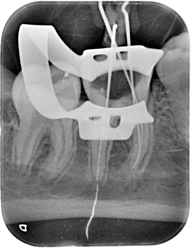 w_a7med's tweet photo. Diagnosis: Pulp Necrosis #46

Treatment: Root Canal Treatment + Composite Restoration https://t.co/w5pziRf3Vm