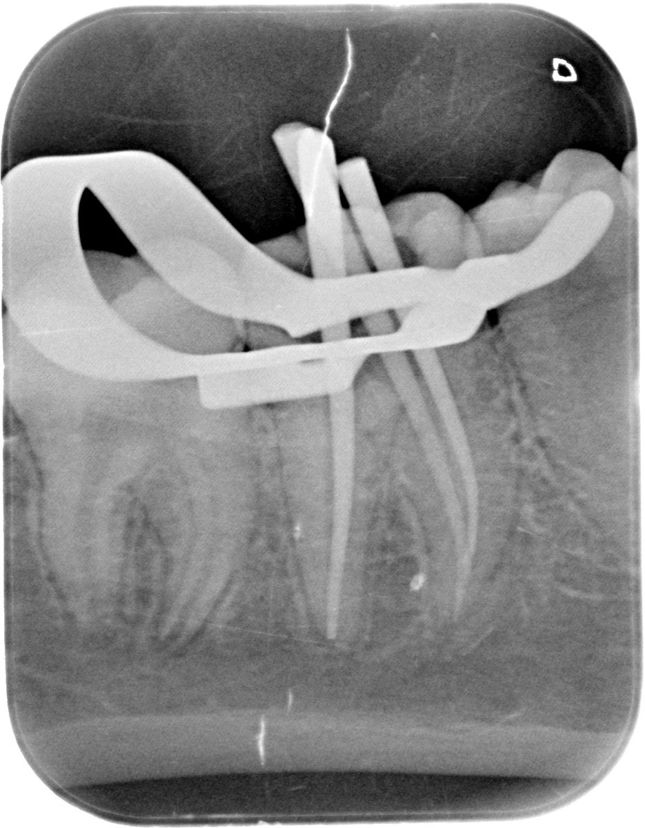 w_a7med's tweet photo. Diagnosis: Pulp Necrosis #46

Treatment: Root Canal Treatment + Composite Restoration https://t.co/w5pziRf3Vm