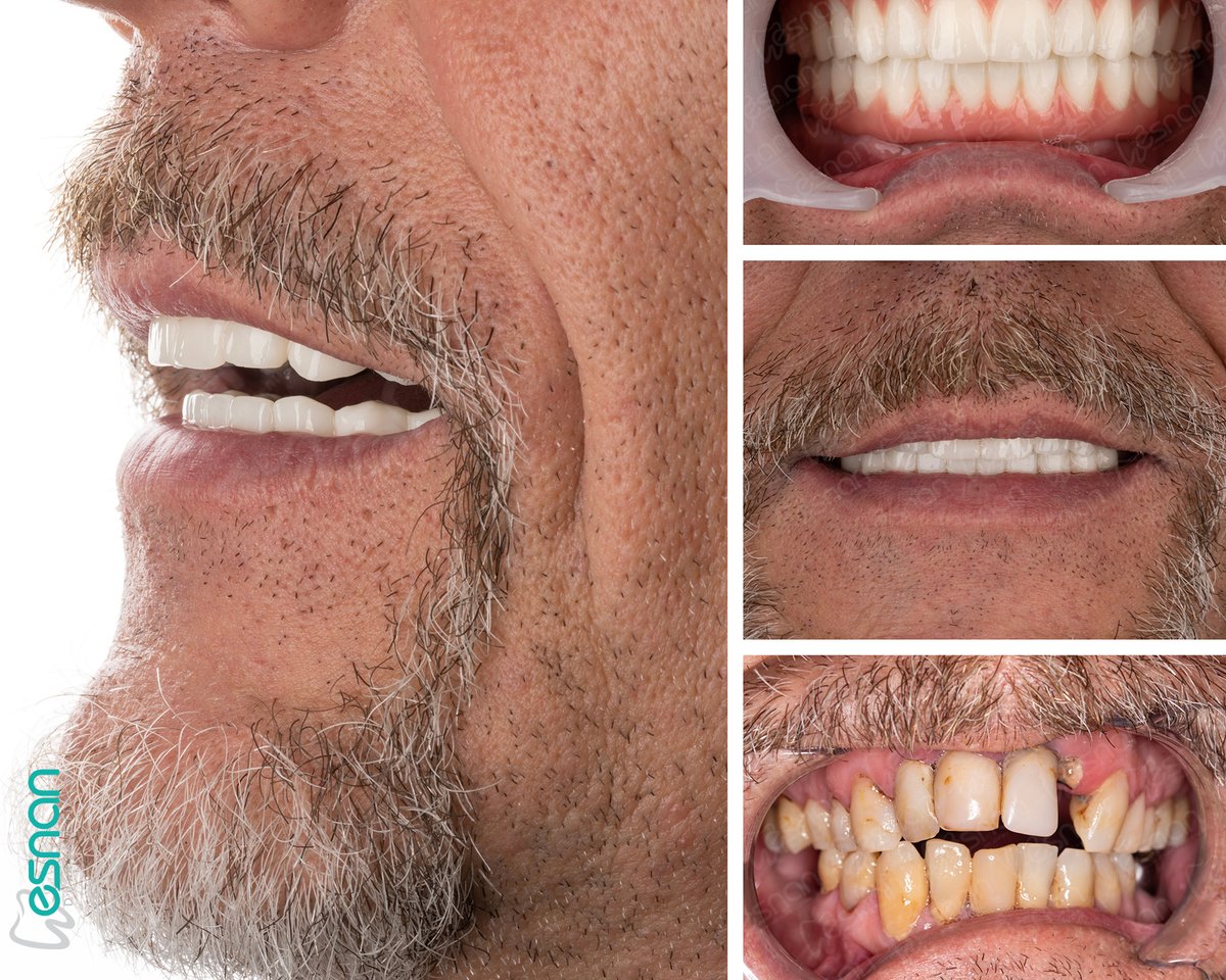 esnanclinics's tweet image. Correct your open bite and achieve a healthy, aesthetic smile with Esnan Dental Clinics. Our expert dentists are here to help. 

Details at: esnandentalclinics.com 🦷💙 

#OpenBite #Dental #healtyteeth