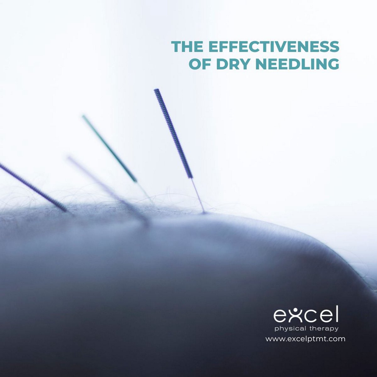 ExcelPTMT's tweet photo. Dry needling is a treatment that may be indicated during a course of physical therapy. It is arguably the most precise tool we have to influence the cortical map, which includes sensation and motor control.

#excelptmt​​​​​​​​ #bozemanpt #bozemanphysicaltherapy https://t.co/KrF5N82fLg