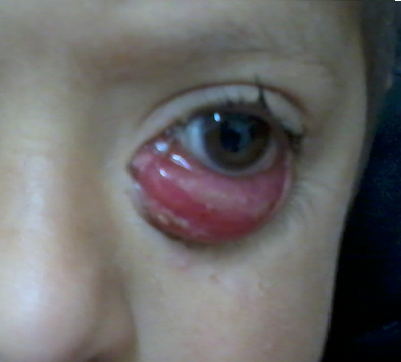 PANAFRMEDJ's tweet image. What is your diagnosis?

Retinoblastome

Pseudotumeur inflammatoire

Rhabdomyosarcome

Entropion inflammatoire

panafrican-med-journal.com/quizz/index.ph…

#Imagequiz #clinicalimage