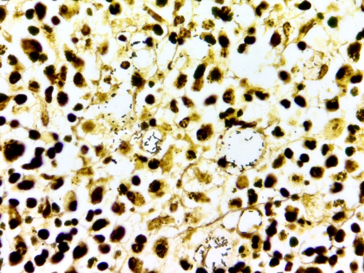 Not something you see everyday! Rhinoscleroma -
👃Nasal cavity mass
🤓Mickulicz cells are the classic clear histiocytes seen (tons of them here)
💥Causative organism - Klebsiella rhinoscleromatis 
Check out that Warthin Starry! 🤩
#ENTpath #Headandneckpathology #pathresidents