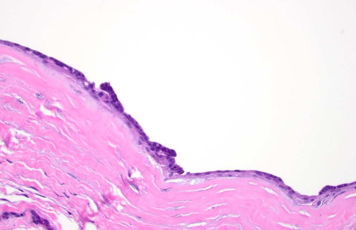 dgbrackett's tweet photo. Good example of a hidrocystoma, I think!
(lateral canthus lesion, also clinically favored to be hidrocystoma)
#eyepath #generalpath https://t.co/MbZsVq2Vsn